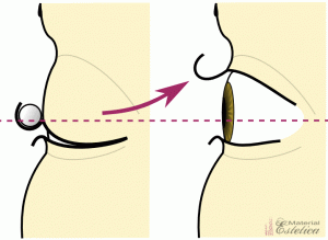 Incorrect Le bigoudi est trop bas pour permanente des cils