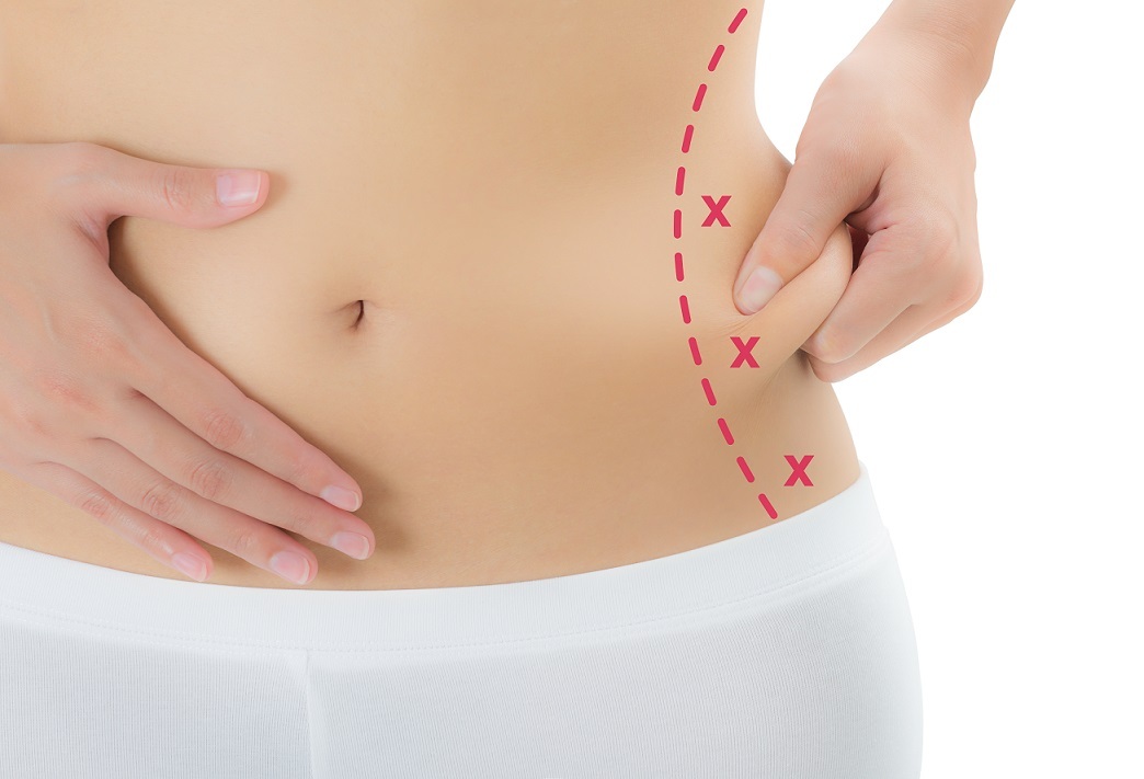 Connaître les avantages de la lipolyse laser