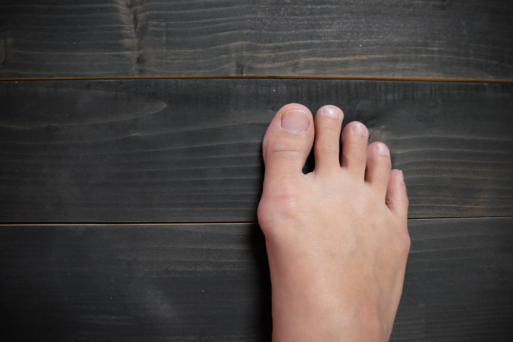 Qu'est-ce qu'un hallux valgus et comment l'éviter